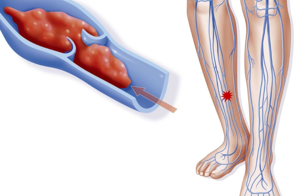 лечение тромбоза глубоких вен нижних конечностей